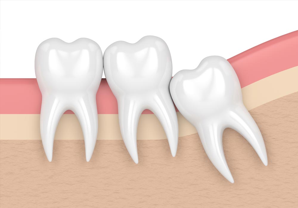 Dents de sagesse Groupe Dentaire Laval